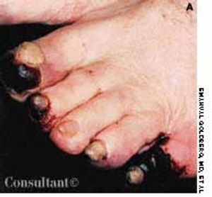 Trash Feet and Mobile Thrombus/Atheroma