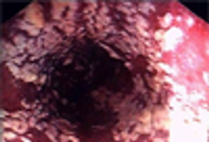 Oroesophageal Candidiasis in a Patient With AIDS