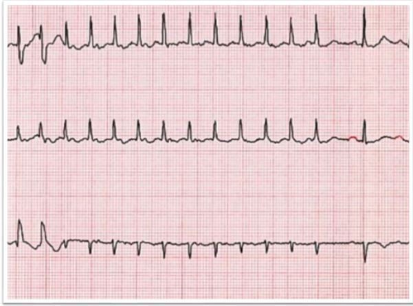 Ablation Complications: Proceed with Caution | Patient Care Online