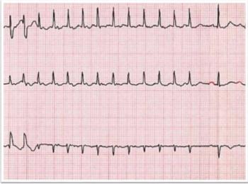 right atrial ablation, atrial flutter, atrial fibrillation