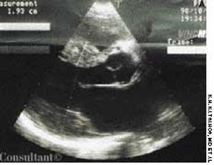 Multiple Myeloma Presenting With CHF