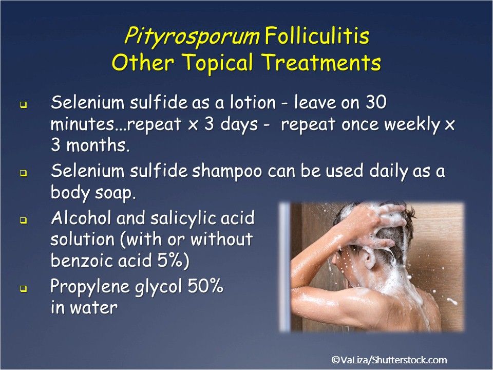 Pitysorporum folliculitis treatment is selenium sulfide, salicylic acid 