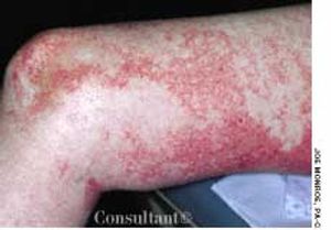 Zinc Deficiency