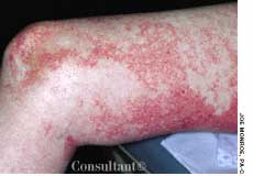 Zinc Deficiency Rashes Zinc Deficiency