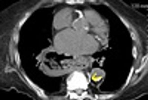 Complications Following Treatment of Osteoporotic Vertebral Fracture