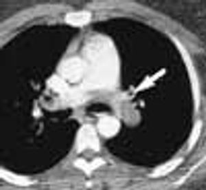 Pulmonary Embolism and Deep Venous Thrombosis