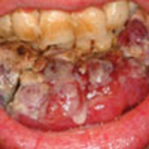 HIV-Associated Lymphoma