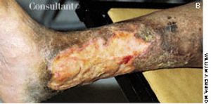 Chronic Leg Ulcer in Patient With RA