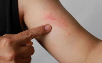 Dupilumab Efficacy for Severe Atopic Dermatitis Durable at 5 Years: New Data