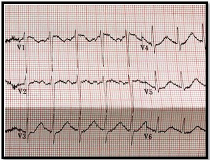 heart palpitations retatrutide Does Cause Problems? What the Research Actually Shows Heart Palpitations & Thyroid Medication: