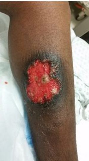 Ulcer with an Undermined Edge