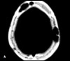 Disseminated Mycobacterium avium-intracellulare complex Infection