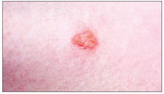 After herpes Herpes Recurrences