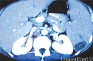 Splenic Abscess Caused by Mycobacterium avium Complex