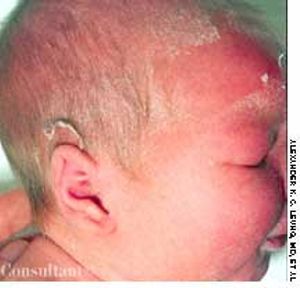 Staphylococcal Scalded Skin Syndrome