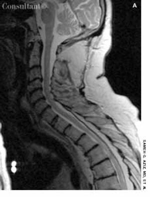 Spinal Epidural Lipomatosis