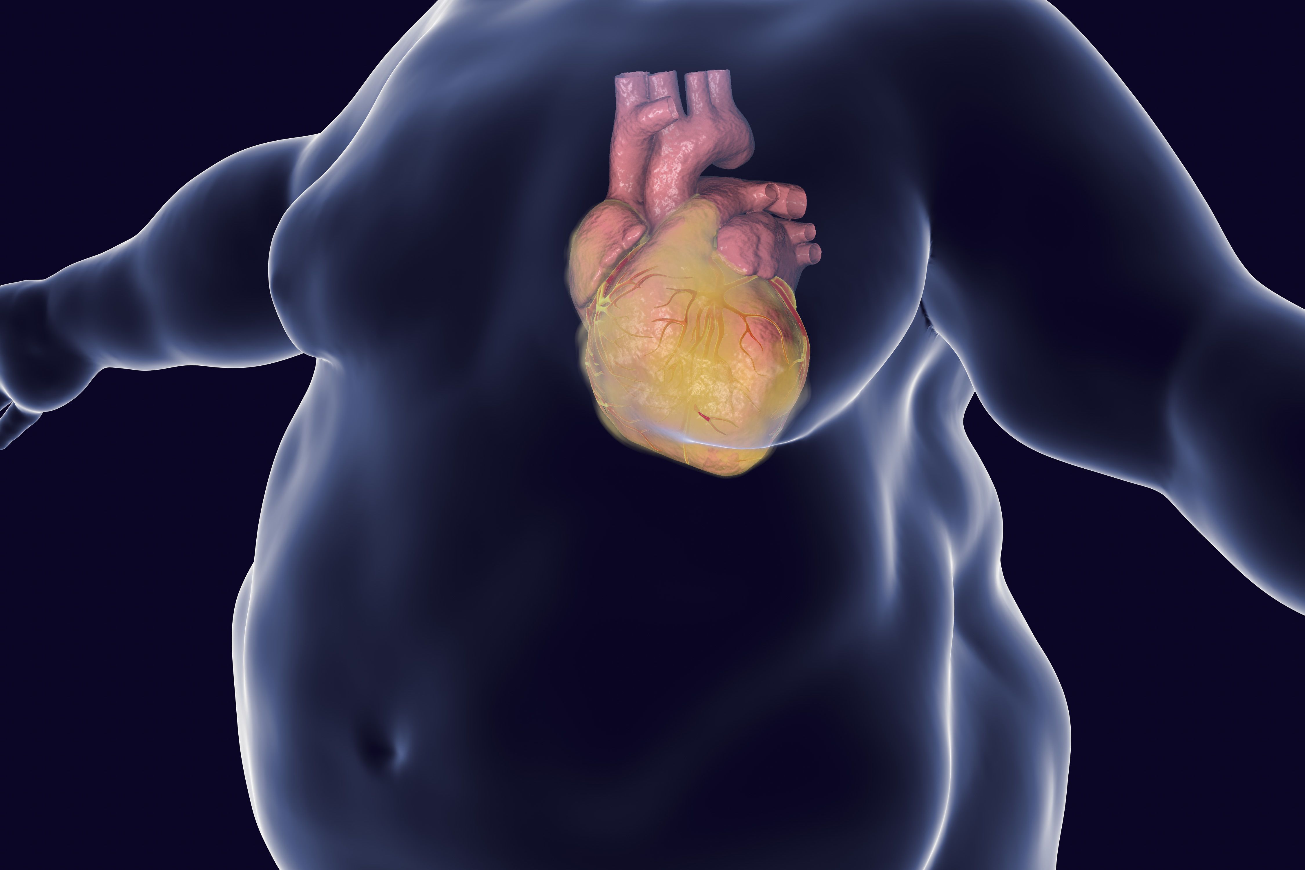 Metabolically Healthy Obesity May Increase Risk of Heart Failure, but Not Heart  Attack or Stroke