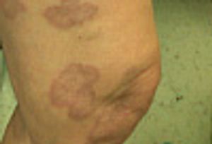 Differentiating Common Annular Lesions: Tinea Corporis vs Granuloma Annulare