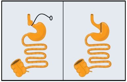 Colorectal cancer resection after bariatric surgery 