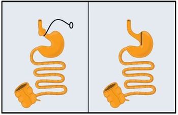 Weight loss surgery may prevent stroke risk 