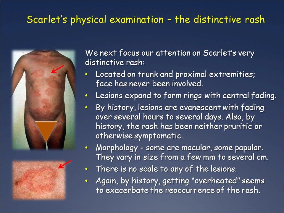 Lesions are evanescent; fade over several hours to days; macular and papular 