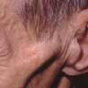 Cachexia Secondary to Pancreatic Cancer? 