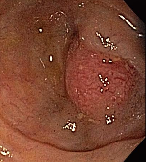 An Incidental Mass Found in the Terminal Ileum