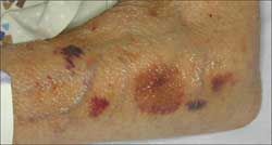 Skin Disorders In Older Adults Vascular Lymphatic And Purpuric Dermatitides Part 1