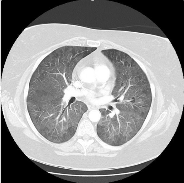 A Non-smoker with Progressive Dyspnea, No Cough