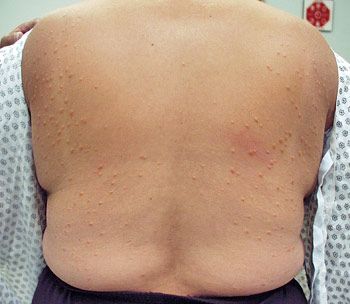 does semaglutide cause increase anxiety Feeling Weak on Semaglutide: Causes and Management Strategies Flavor:Cherry Natural Solutions Accidental Double Dose of