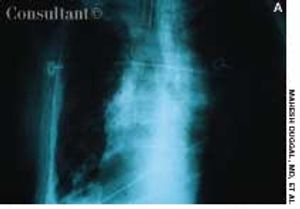 Pleural Calcification