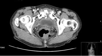Osteomyelitis of pubic symphysis