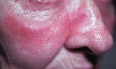 Why is this woman's face red and itchy? | Patient Care Online