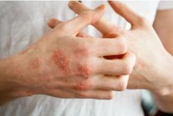 FDA Accepts NDA for Delgocitinib Cream, Developed Specifically to Treat Chronic Hand Eczema 