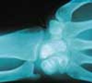 Congenital Absence of Carpal Navicular Bone