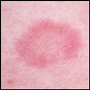 Why has this annular rash resisted antifungals?
