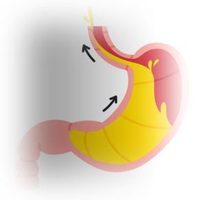 Sebela Submits NDA for Tegoprazan for GERD, Seeking Approval for NERD and Erosive Esophagitis