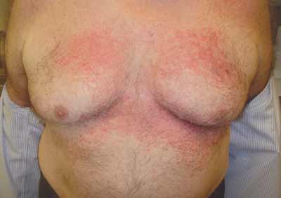 thrush rash