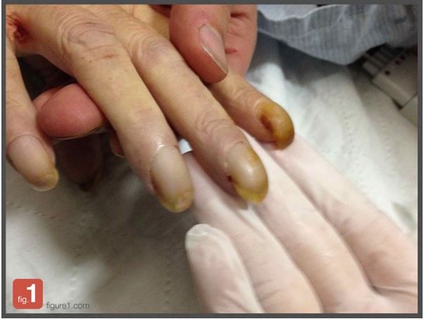 Fingernail Clubbing: A Sign of Lung Cancer?