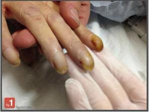 Fingernail Clubbing: A Sign of Lung Cancer?