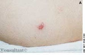 Herpes Zoster in Multiple Dermatomes