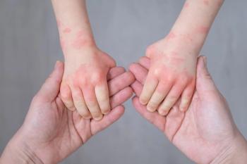 Arcutis Begins Study of Roflumilast Cream 0.05% in Infants with Atopic Dermatitis / Image credit: ©Юля Шевцова/AdobeStock