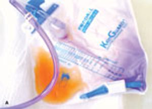 Purple Urine Bag Syndrome