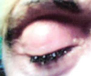 Accidental Ocular Installation of “Stomahesive”