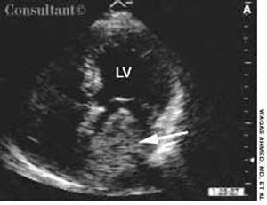 Atrial Myxoma That Mimics Mitral Stenosis