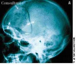 Migrated Intracranial Aneurysm Clip