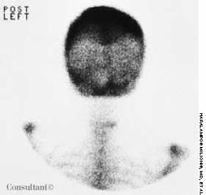 Paget's Disease of Bone