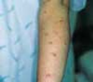 Pruritic urticarial papules and plaques of pregnancy (PUPPP)