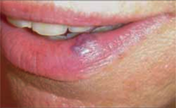 Venous lakes