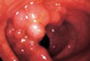 Villous Adenoma in a 61-Year-Old Man